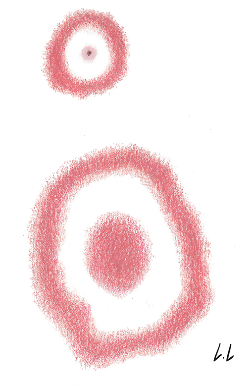 L&eacute;sion morsure de tique